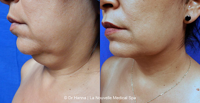 Liposuction, Smartlipo before after photos Ventura County, Dr. Hanna La Nouvelle Medical Spa, Oxnard