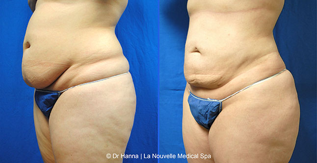 Liposuction, Smartlipo before after photos Ventura County, Dr. Hanna La Nouvelle Medical Spa, Oxnard