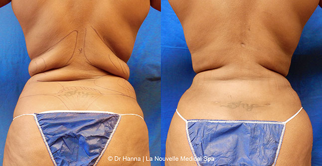 Liposuction, Smartlipo before after photos Ventura County, Dr. Hanna La Nouvelle Medical Spa, Oxnard