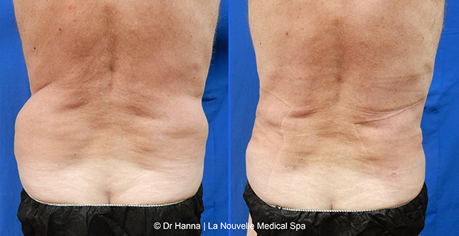 Liposuction, Smartlipo before after photos Ventura County, Dr. Hanna La Nouvelle Medical Spa, Oxnard