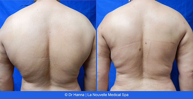 Liposuction, Smartlipo before after photos Ventura County, Dr. Hanna La Nouvelle Medical Spa, Oxnard