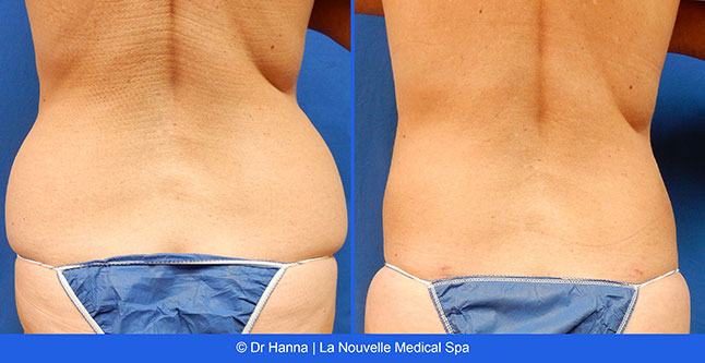 Liposuction, Smartlipo before after photos Ventura County, Dr. Hanna La Nouvelle Medical Spa, Oxnard