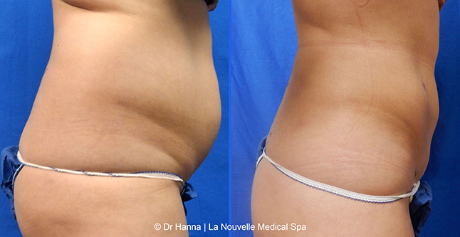 Liposuction, Smartlipo before after photos Ventura County, Dr. Hanna La Nouvelle Medical Spa, Oxnard