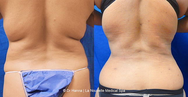 Liposuction, Smartlipo before after photos Ventura County, Dr. Hanna La Nouvelle Medical Spa, Oxnard