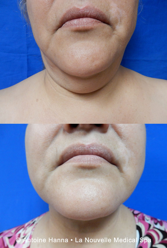 neck liposuction before after by dr hanna la nouvelle spa oxnard