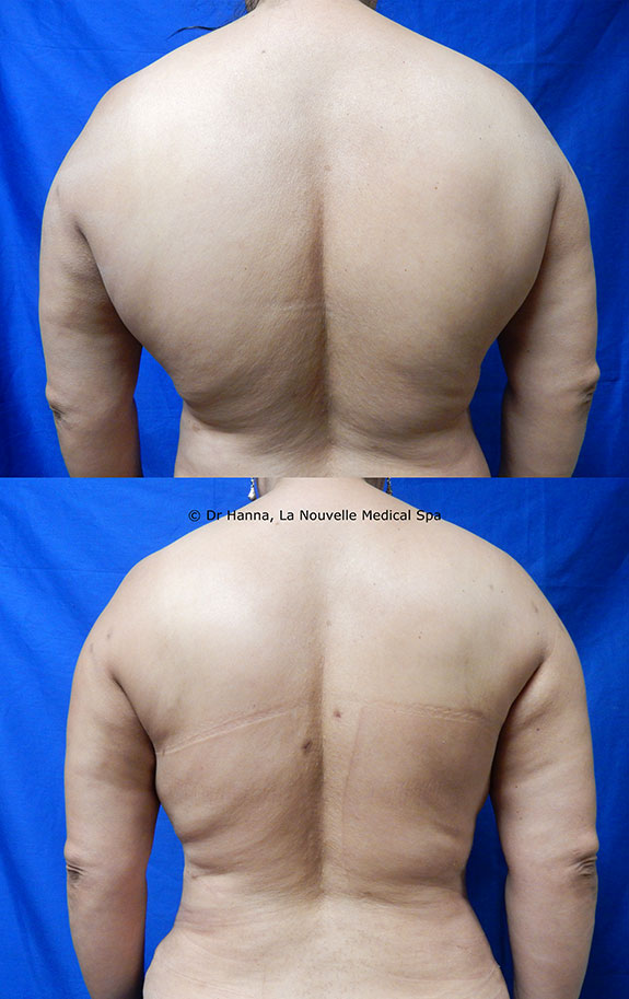 female liposuction on back by dr hanna la nouvelle spa oxnard