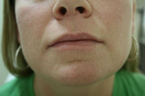fillers, radiesse, juvederm, restylane before and after