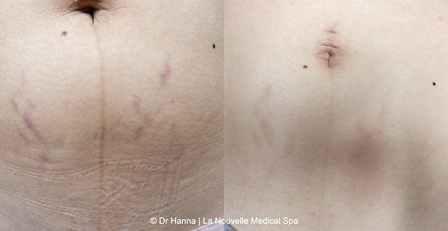 stretch marks before and after photos la nouvelle medical spa oxnard ventura