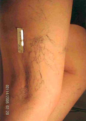 Laser Hair Removal - Chin