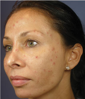 VI Peel acne before after la nouvelle medical spa