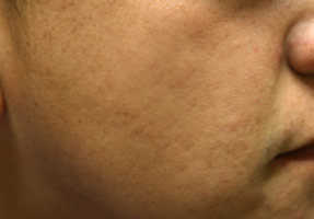 acne treatment before and after la nouvelle, oxnard, ventura