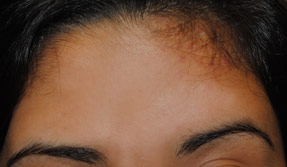 acne treatment before and after la nouvelle, oxnard, ventura