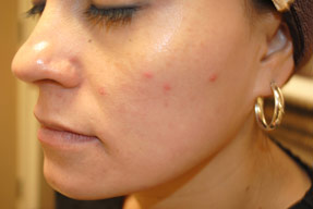 acne treatment before and after la nouvelle, oxnard, ventura