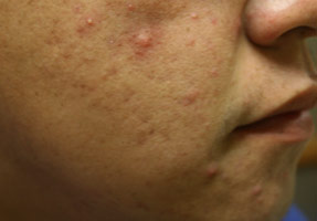 acne treatment before and after la nouvelle, oxnard, ventura