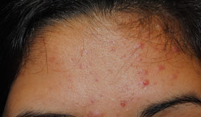 acne treatment before and after la nouvelle, oxnard, ventura