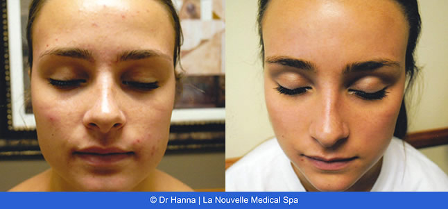 Laser Acne Treatment - acne scars before