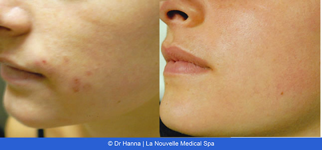 Laser Acne Treatment - acne scars before