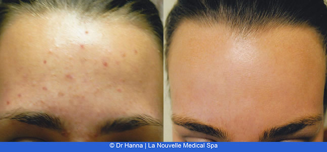 Laser Acne Treatment - acne scars before