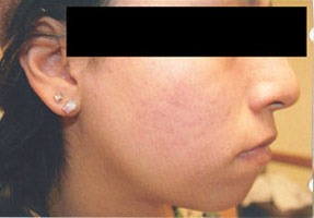 acne treatment before and after la nouvelle, oxnard, ventura