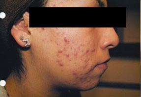 acne treatment before and after la nouvelle, oxnard, ventura