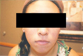 acne treatment before and after la nouvelle, oxnard, ventura