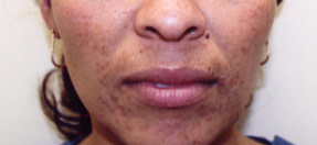 acne treatment before and after la nouvelle, oxnard, ventura