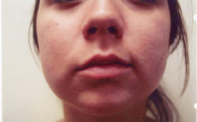 acne treatment before and after la nouvelle, oxnard, ventura