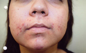 acne treatment before and after la nouvelle, oxnard, ventura