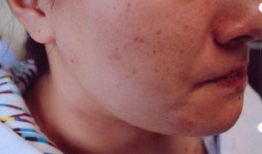 acne treatment before and after la nouvelle, oxnard, ventura