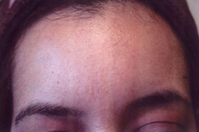 acne treatment before and after la nouvelle, oxnard, ventura