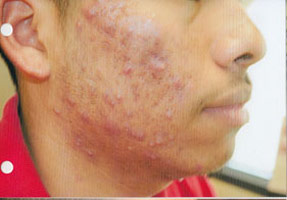 acne treatment before and after la nouvelle, oxnard, ventura