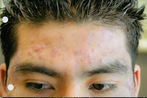 acne treatment before and after la nouvelle, oxnard, ventura