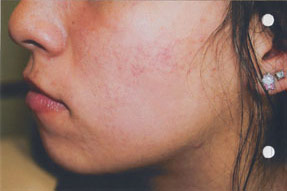 acne treatment before and after la nouvelle, oxnard, ventura