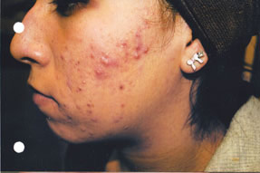 acne treatment before and after la nouvelle, oxnard, ventura