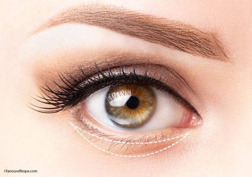 blepharoplasty-lower-eyelid-surgery-ventura-county-dr-hanna-la-nouvelle