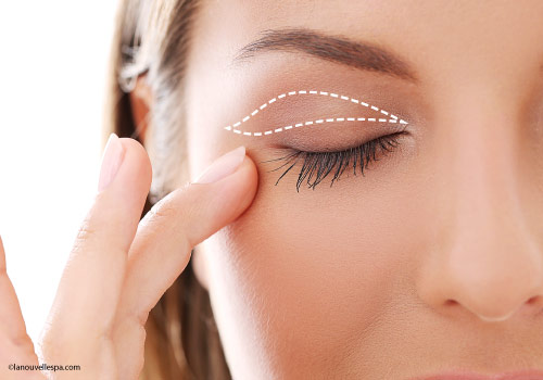 blepharoplasty-upper-eyelid-surgery-ventura-county-dr-hanna-la-nouvelle