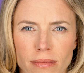 Botox injections for wrinkle removal - after photo, dr hanna, la nouvelle oxnard, ventura county