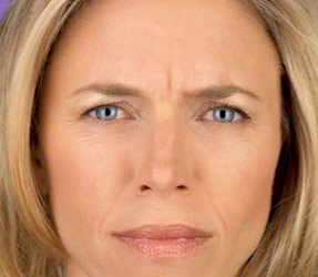 Botox injections for wrinkle removal - before photo, dr hanna, la nouvelle oxnard, ventura county