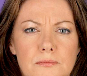 Botox injections for wrinkle removal - before photo, dr hanna, la nouvelle oxnard, ventura county