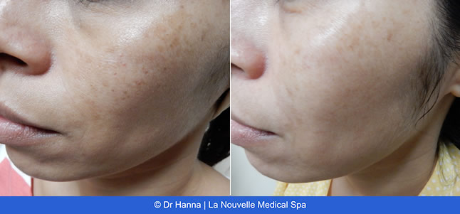 Chemical Peels VI Peel before after photos, La Nouvelle Medical Spa, Oxnard, Ventura County