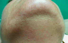 Laser Hair Removal - Chin