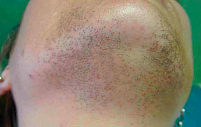 Laser Hair Removal - Chin