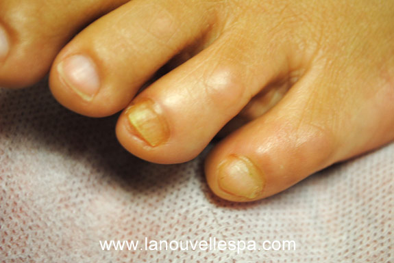 laser genesis for treating of toenails la nouvelle spa oxnard