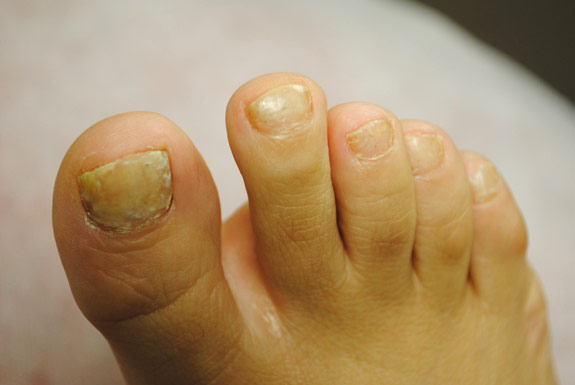 laser genesis for treating of toenails la nouvelle spa oxnard