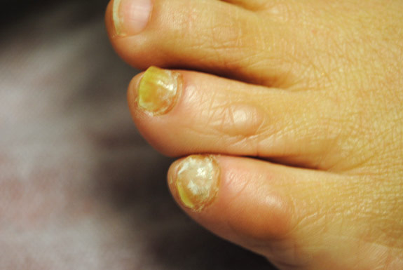 laser genesis for treating of toenails la nouvelle spa oxnard