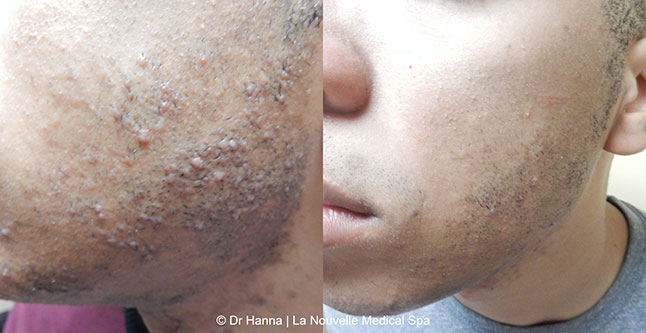 Laser hair removal treatments before and after Ventura County, La Nouvelle Medical Spa, Oxnard