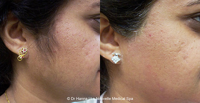 Laser hair removal treatments before and after Ventura County, La Nouvelle Medical Spa, Oxnard