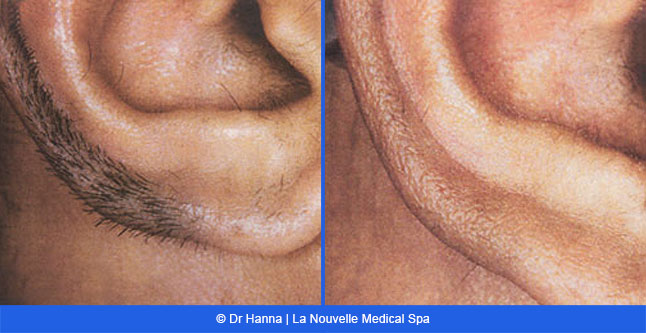 Laser hair removal treatments before and after Ventura County, La Nouvelle Medical Spa, Oxnard