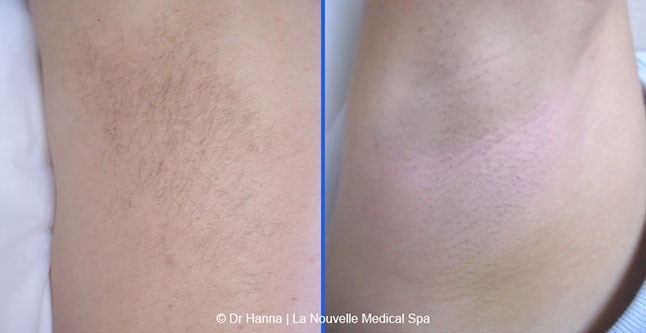 Laser hair removal treatments before and after Ventura County, La Nouvelle Medical Spa, Oxnard