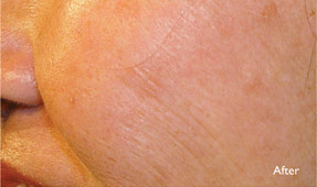 Laser IPL - sun spots after